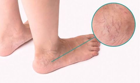 Varicose Vein Treatment Guide: Vascular Procedures, Symptoms, and Recovery