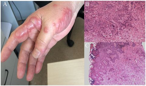 A Guide to Avium Infections Understanding Mycobacterium Avium Complex MAC