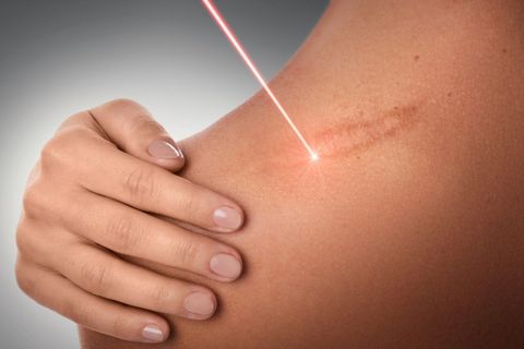 Expert Tips for Non-Surgical Laser Scar Removal and Skin Recovery