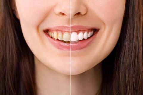 Teeth Whitening: Explore How Modern Whitening Methods Work