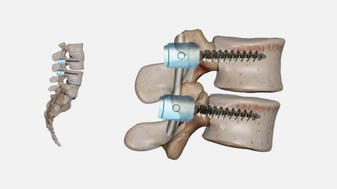 Spinal Surgery Guide: Treatment Procedures, Surgical Options, and Recovery