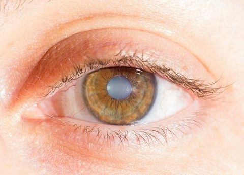 Discover How Early Cataract Awareness Protects Your Vision