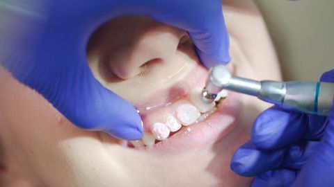 Dental Sealants Basics: Understanding Types, Uses, and Long-Term Protection