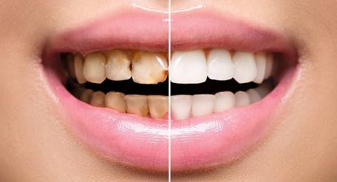 Dental Restoration Guide: Crowns, Implant Procedures, and Oral Health Information