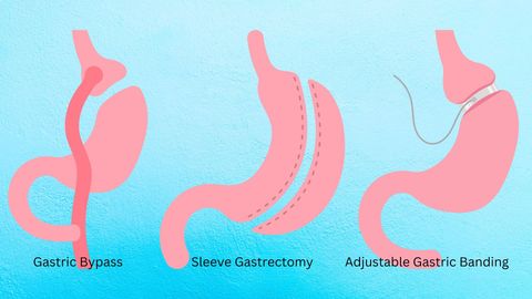 Bariatric Surgery Guide: Weight-Loss Procedures, Recovery, and Health Planning