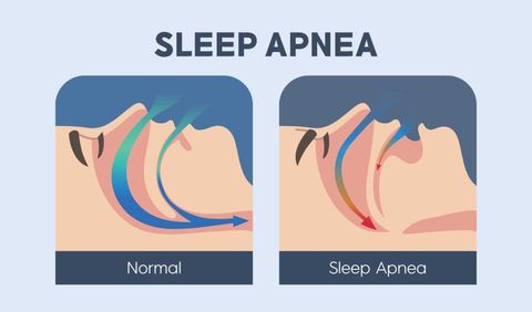 Sleep Apnea Guide: Diagnostic Testing, CPAP Therapy, and Sleep Health