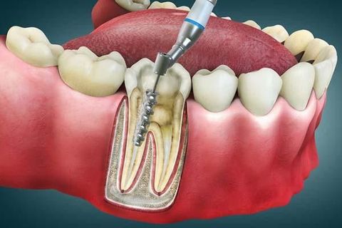 Guide to Root Canal Treatment: Dental Procedures, Recovery Information, and Oral Health