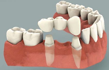 Dental Veneers Guide: Treatment Options, Cosmetic Procedures, and Oral Care