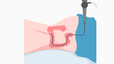 Colonoscopy Guide: Screening Preparation, Procedures, and Digestive Health