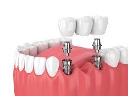 Dental Implant Method: Complete Guide, Basics, Procedure Overview, Tips, Benefits, and Expert Insights