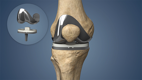 Knee Replacement Guide: Surgical Procedures, Implant Options, and Recovery