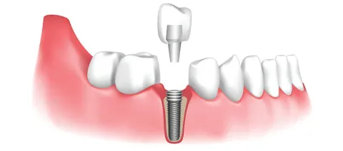 Dental Implant Guide: Implant Procedures, Restoration Options, and Oral Care