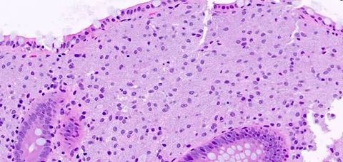 Guide to MAC Lung Disease: Symptoms, Diagnosis, and Treatment Options