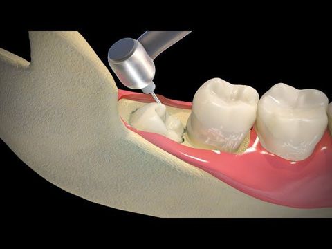Helpful Advice for Faster Healing After Wisdom Tooth Extraction